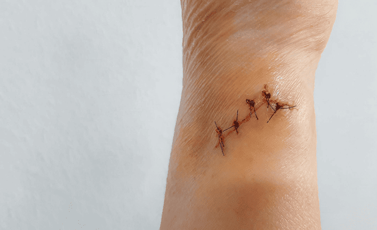 Sutura de heridas: Técnicas avanzadas para una cicatrización óptima
